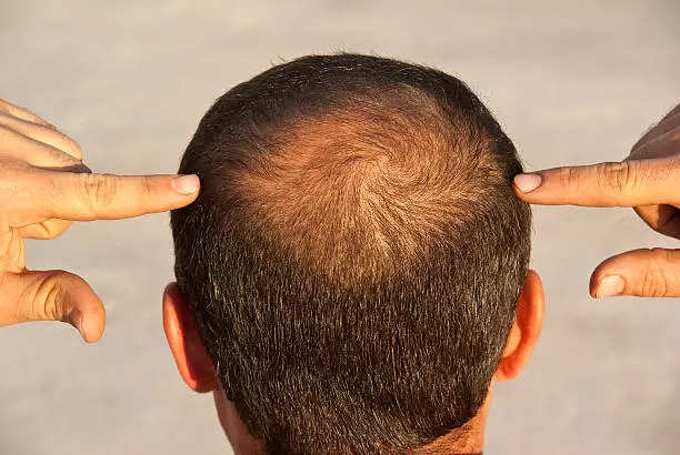 How to use Jojoba Oil to grow hair in bald patches