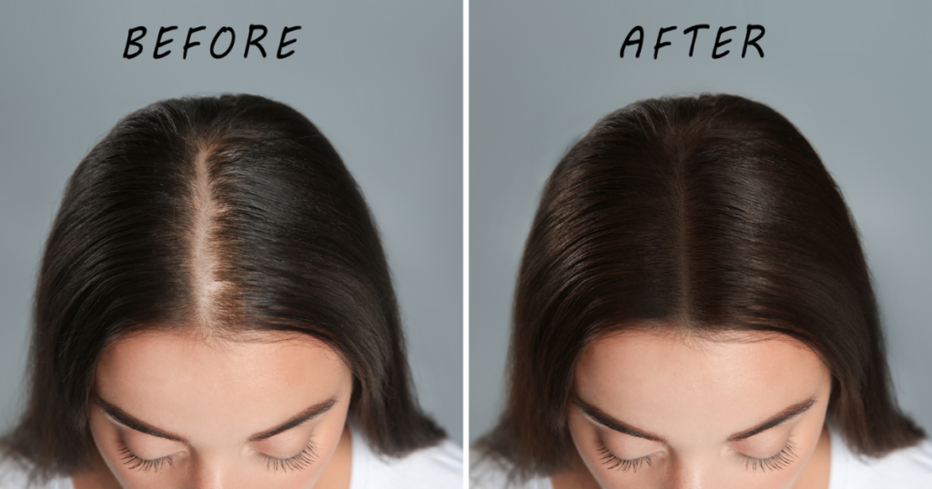 How to massage Coconut Oil to regrow hair in bald patches