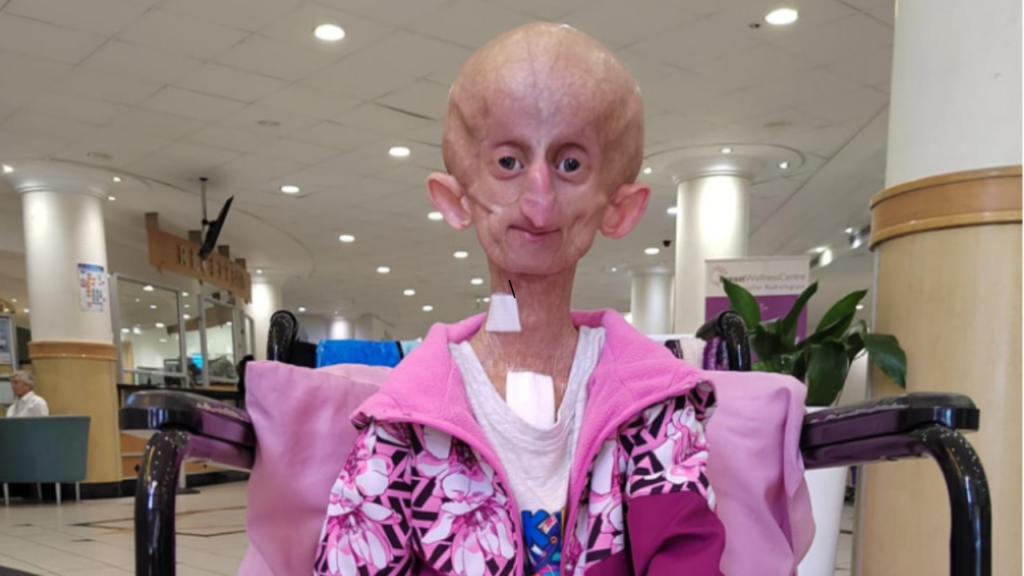 Who was Beandri Booysen? TikTok star died due to rare aging disease 'Progeria'