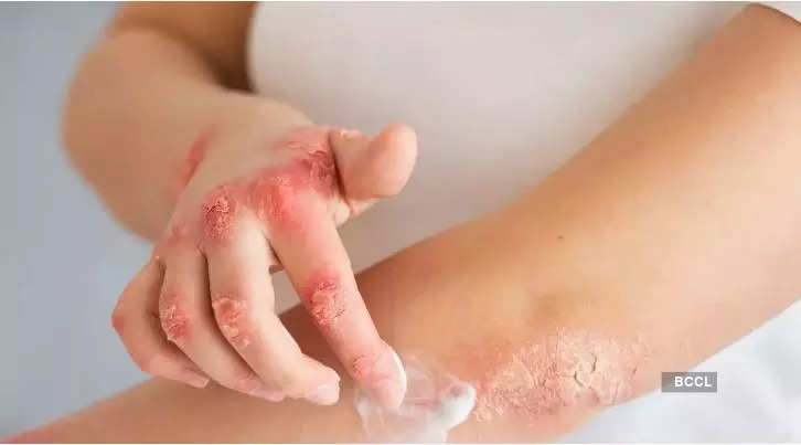 6 ways to prevent psoriasis flare-ups in winter