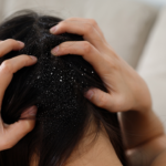 6 dandruff remedies for a squeaky clean scalp