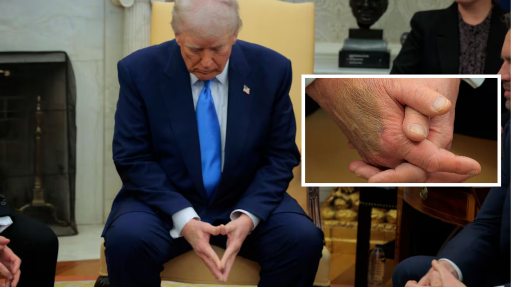 Mysterious bruise on Trump’s hand sparks speculation: What’s the real story?