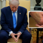 Mysterious bruise on Trump’s hand sparks speculation: What’s the real story?